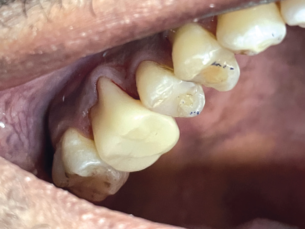 Conservative rehabilitation of a supraerupted #3 with a failing amalgam using CAMouflage NOW, relieving sensitivity and restoring function with a new lower DuraFlex™ partial (Myerson, Chicago, Ill.).