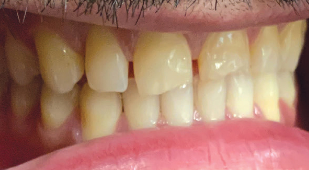 BioTemps NOW provisionals support Dentologie’s patient-centered workflow by delivering esthetic, efficient interim restorations that keep treatment moving while maintaining a strong clinical experience.