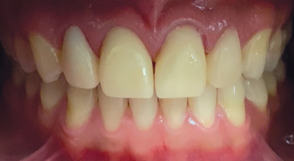 BioTemps NOW provisionals support Dentologie’s patient-centered workflow by delivering esthetic, efficient interim restorations that keep treatment moving while maintaining a strong clinical experience.