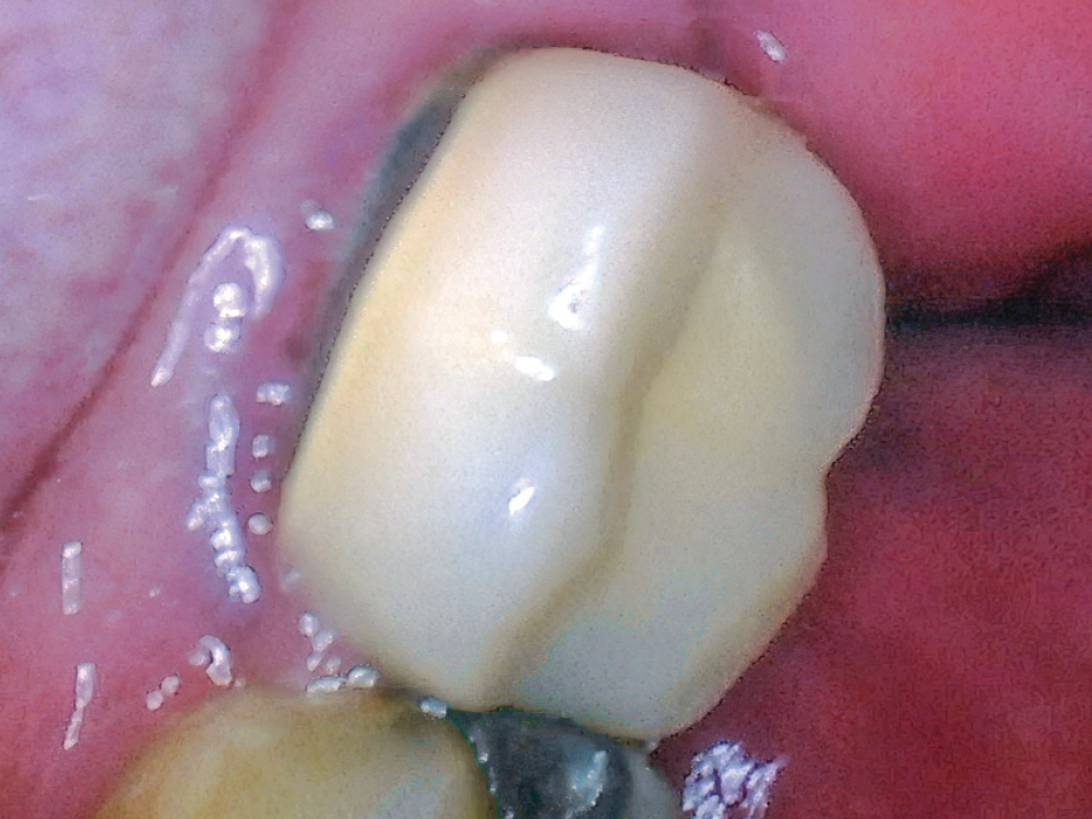Dr. Todd Curley’s patient presented decay and an open margin on the distal lingual of an old PFM crown. An Obsidian block in shade A2 was milled using the fastmill.io.