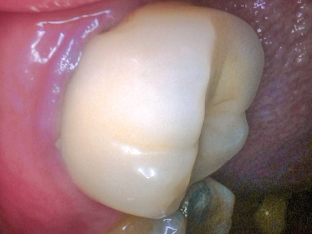 Dr. Todd Curley’s patient presented decay and an open margin on the distal lingual of an old PFM crown. An Obsidian block in shade A2 was milled using the fastmill.io.