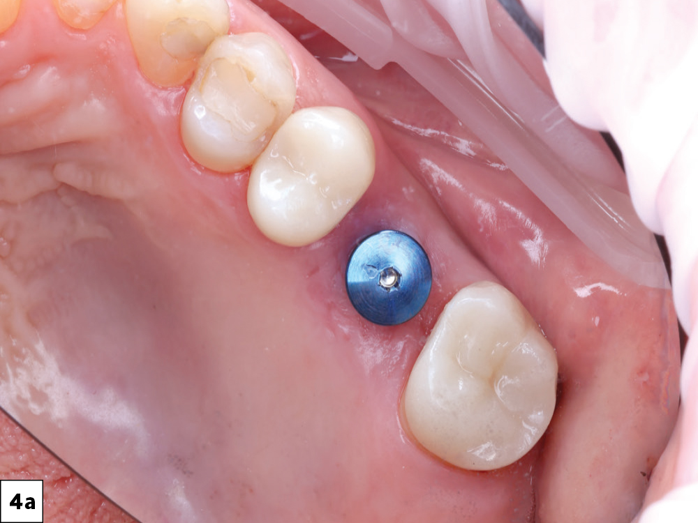 The 3-mm-tall healing abutment was unscrewed, revealing healthy keratinized soft tissue. Implant stability was confirmed using the Penguin RFA® device (Aseptico Inc.; Woodinville, Wash.) with an implant stability quotient 