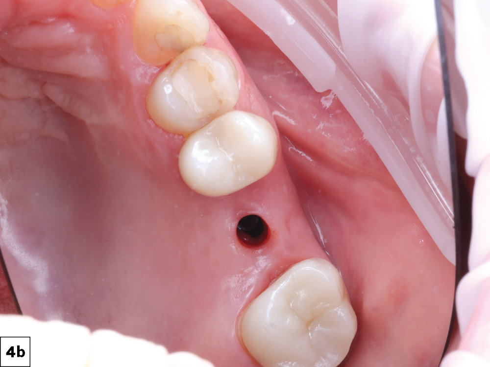 The 3-mm-tall healing abutment was unscrewed, revealing healthy keratinized soft tissue. Implant stability was confirmed using the Penguin RFA® device (Aseptico Inc.; Woodinville, Wash.) with an implant stability quotient