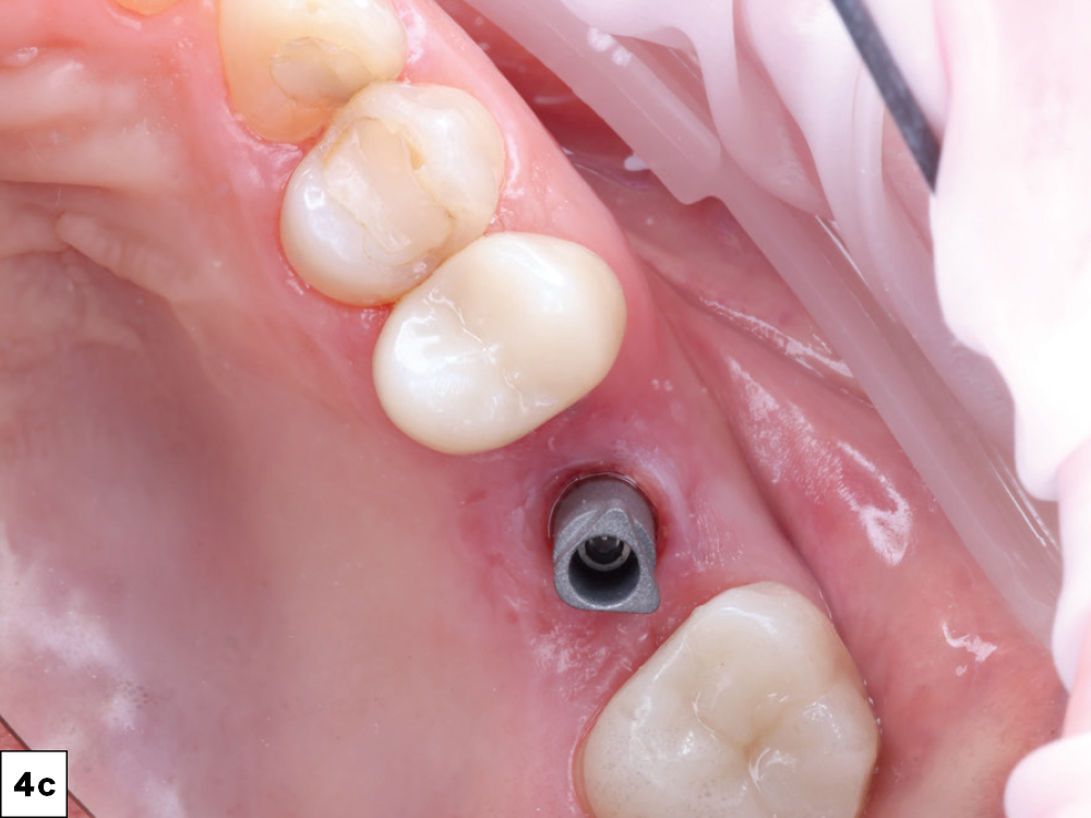The 3-mm-tall healing abutment was unscrewed, revealing healthy keratinized soft tissue. Implant stability was confirmed using the Penguin RFA® device (Aseptico Inc.; Woodinville, Wash.) with an implant stability quotient 