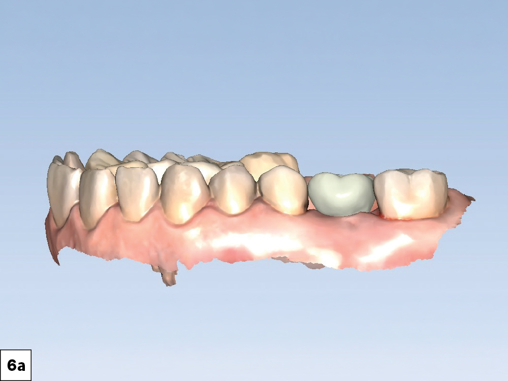Proposed anatomy and design of the crown as shown in the fastdesign.io software.