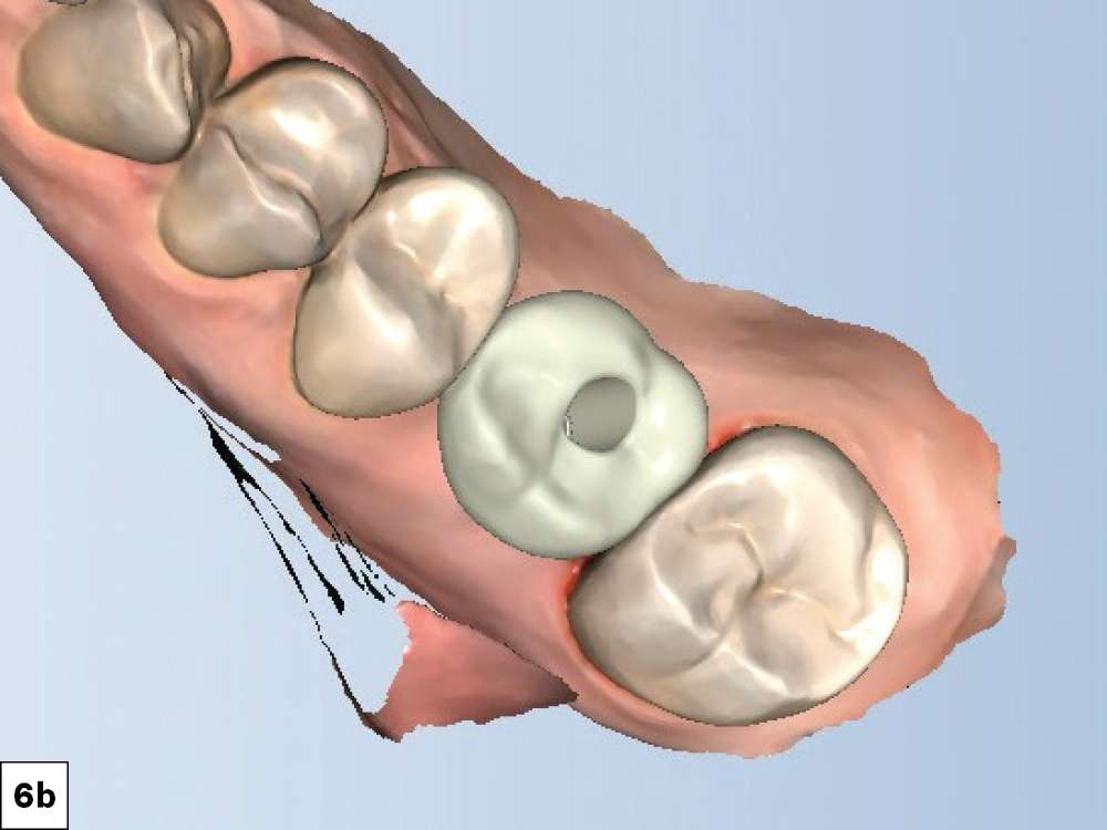 Proposed anatomy and design of the crown as shown in the fastdesign.io software.