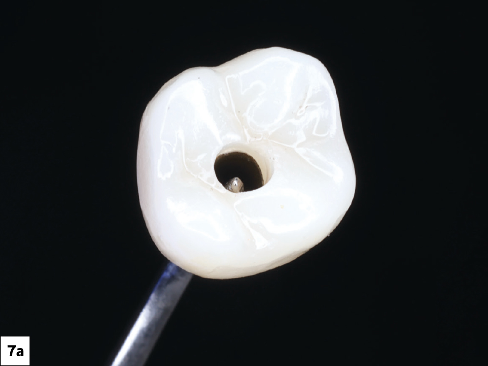 Final in-office-milled BruxZir NOW SRC immediately after chairside milling and hand polishing.