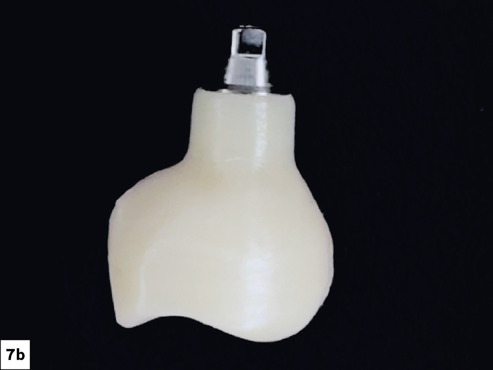 Final in-office-milled BruxZir NOW SRC immediately after chairside milling and hand polishing.