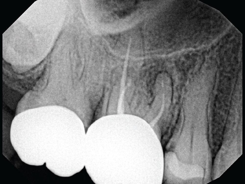 Preoperative X-ray of tooth #3 demonstrated failed root canal therapy. 
