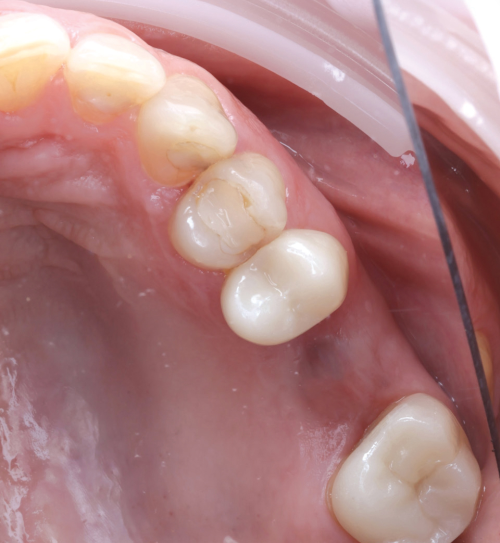 Surgical site demonstrating adequate soft-tissue healing prior to implant placement.