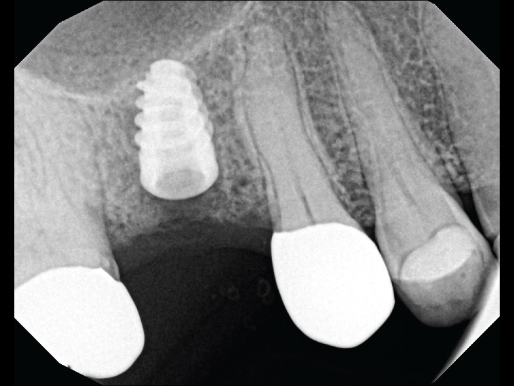 A 5 mm x 10 mm Glidewell HT™ Implant (Glidewell Direct) was placed 1 mm subcrestally
