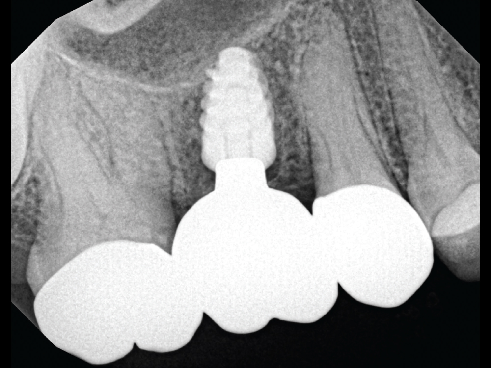 The proven digital workflow combining the Glidewell HT Implant and glidewell.io™  In-Office Solution enabled an efficient procedure for the restoration of this implant. 