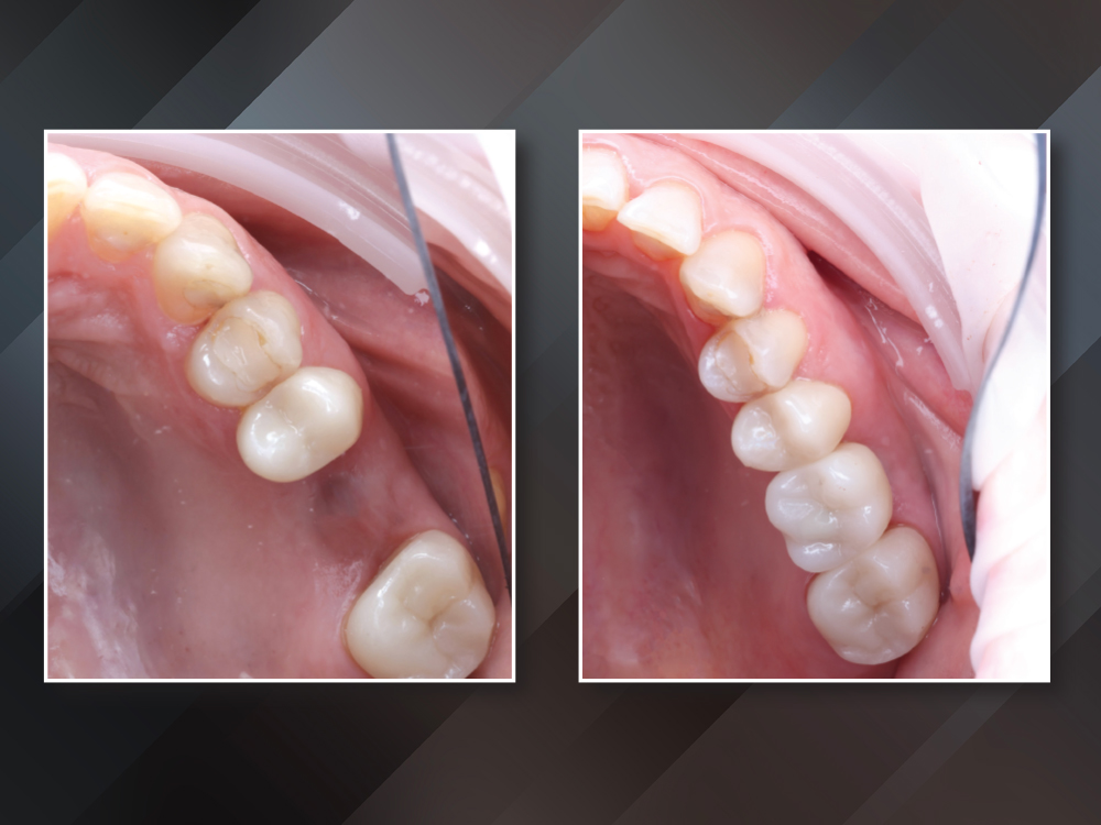 From Failed Root Canal  to Implant Success