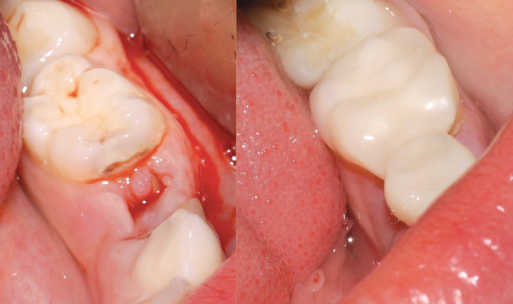 A 5-year-old patient needed primary tooth L removed and a space maintainer placed, but the parents were hesitant to have the unesthetic look of a metal space maintainer in his mouth