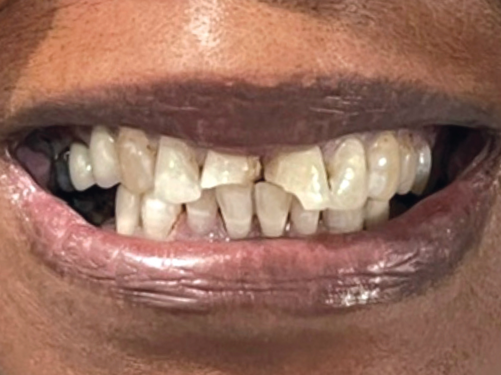 The patient presented significant fractures on #8 and #9. I milled two BruxZir® Esthetic NOW crowns and cemented them the same day