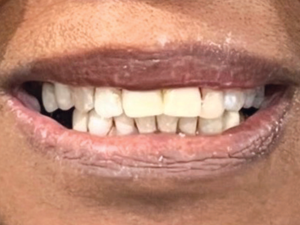 The patient presented significant fractures on #8 and #9. I milled two BruxZir® Esthetic NOW crowns and cemented them the same day