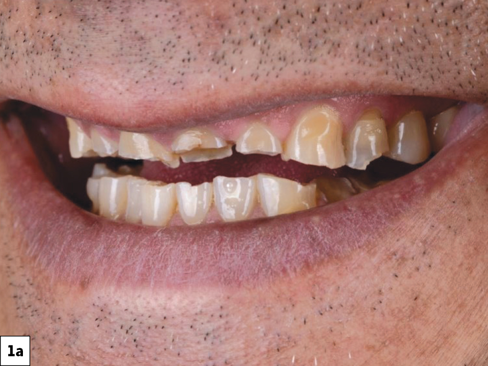 Facial view of a patient's smile showing severely worn and fractured upper and lower anterior teeth.