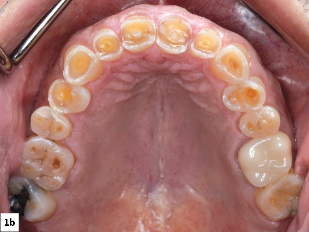 Occlusal intraoral view of the maxillary arch showing generalized severe tooth wear and decay throughout.