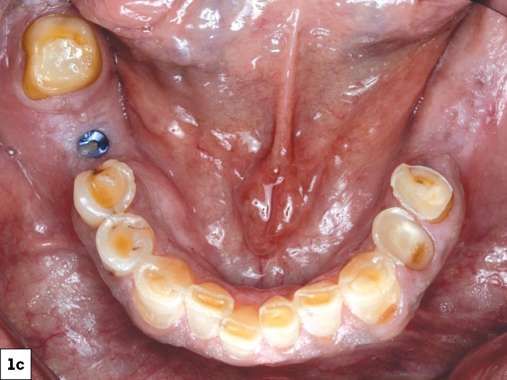 Occlusal intraoral view of the mandibular arch showing severely worn and decayed teeth with missing anterior teeth.