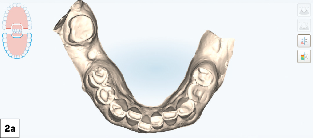 iTero intraoral scan showing the mandibular arch with severely worn dentition, buccal view.
