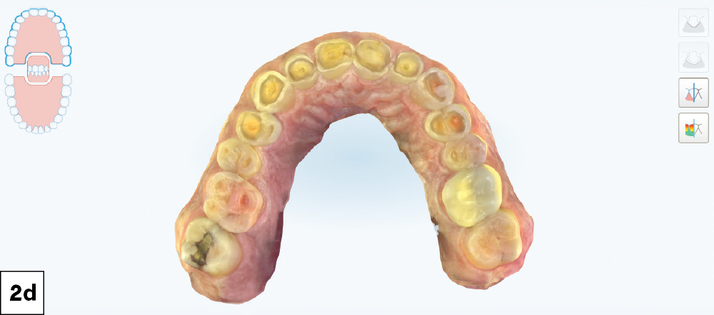 Color iTero intraoral scan of the maxillary arch showing generalized severe wear and decay, occlusal view.