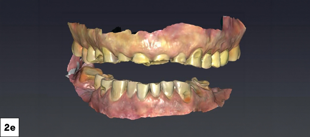 Color iTero intraoral scan showing both arches separated, revealing the extent of full-mouth wear and tooth loss.