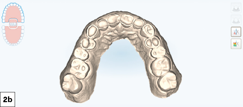 iTero intraoral scan showing the mandibular arch with severely worn dentition, occlusal view.