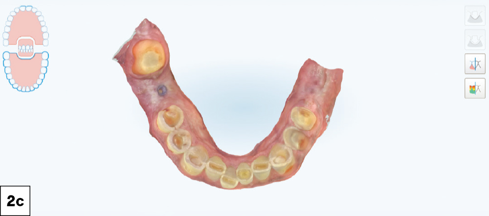 Color iTero intraoral scan of the mandibular arch showing worn and decayed teeth, occlusal view.