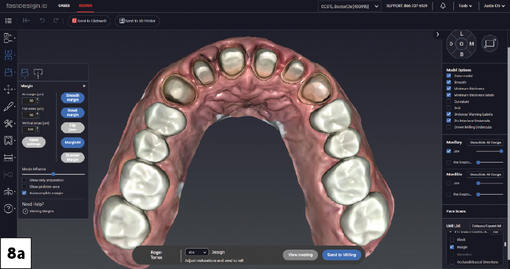 Margin detection view of maxillary posterior crown preparations in fastdesign.io, occlusal view.