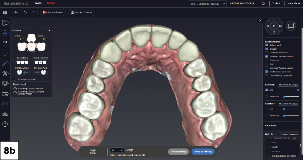 Contact adjustment view of maxillary crown designs in fastdesign.io, occlusal view.