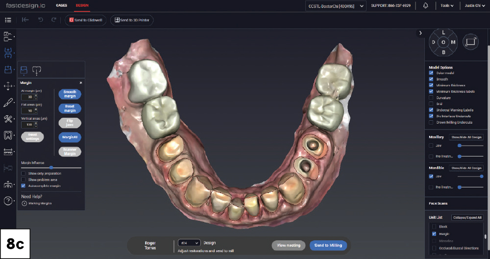 Margin detection view of mandibular posterior crown and veneer preparations in fastdesign.io, occlusal view.