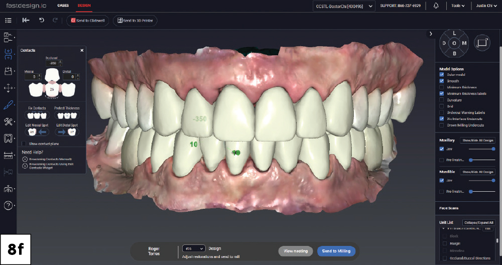 Both arches in occlusion in fastdesign.io showing completed full-mouth crown and veneer designs with contact data, facial view.