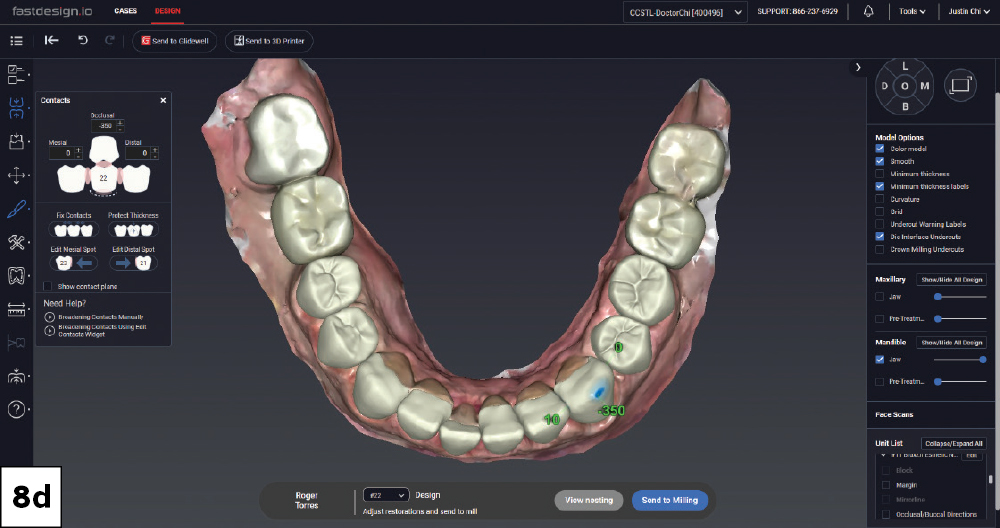 Contact adjustment view of mandibular crown and veneer designs in fastdesign.io, occlusal view.
