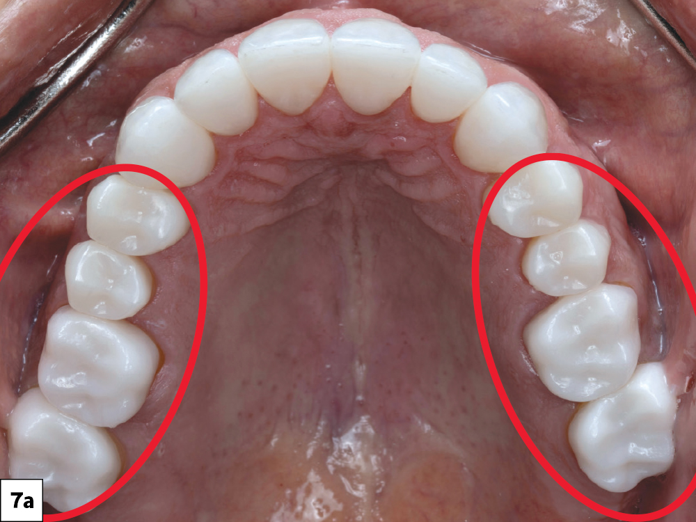 Occlusal intraoral view of the maxillary arch with bilateral posterior BruxZir crowns highlighted, showing completed restorations.
