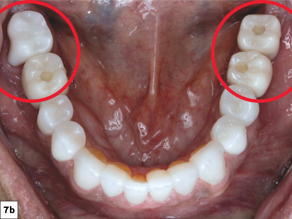 Occlusal intraoral view of the mandibular arch with bilateral posterior BruxZir crowns and implant restorations highlighted, showing completed restorations.