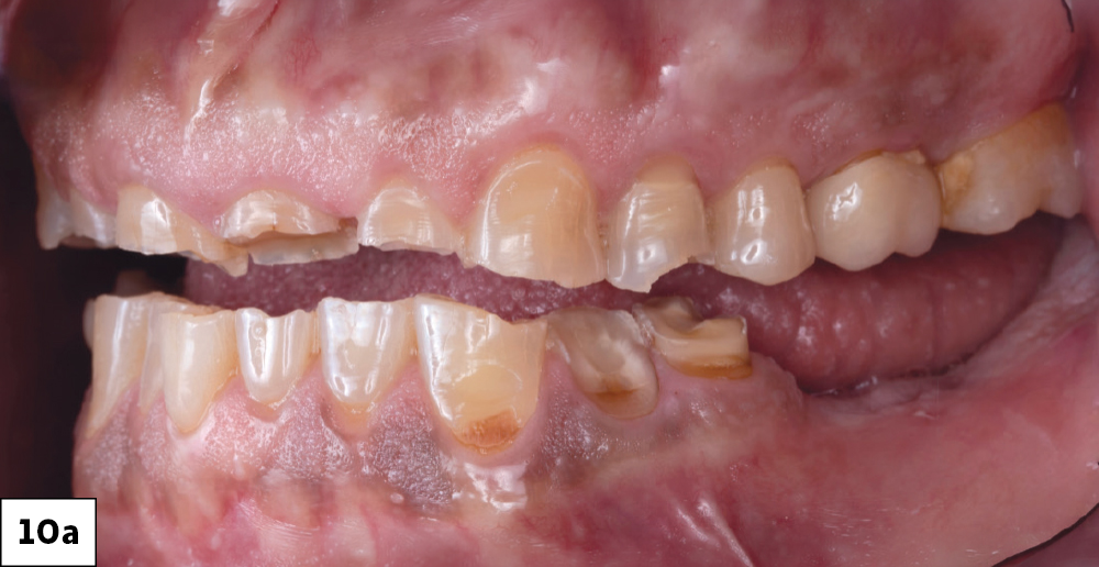 Pretreatment lateral intraoral view showing severely worn and damaged dentition on both arches.