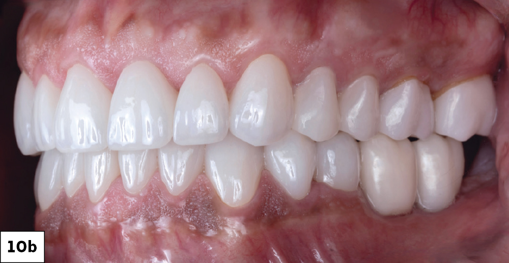 Post-treatment lateral intraoral view showing completed full-mouth BruxZir restorations with restored occlusion, left side.