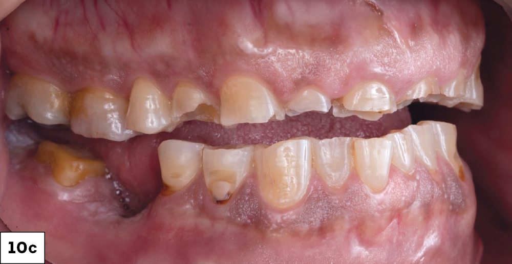 Pretreatment lateral intraoral view showing severely worn dentition on the right side.