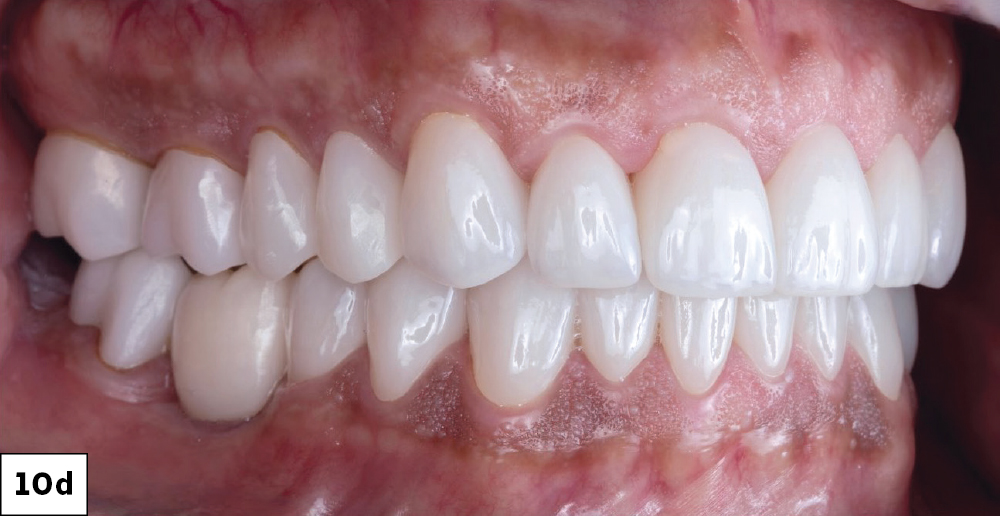 Post-treatment lateral intraoral view showing completed full-mouth BruxZir restorations with restored occlusion, right side.