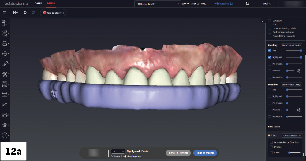 Nightguard design over the maxillary arch displayed in fastdesign.io, lateral view.