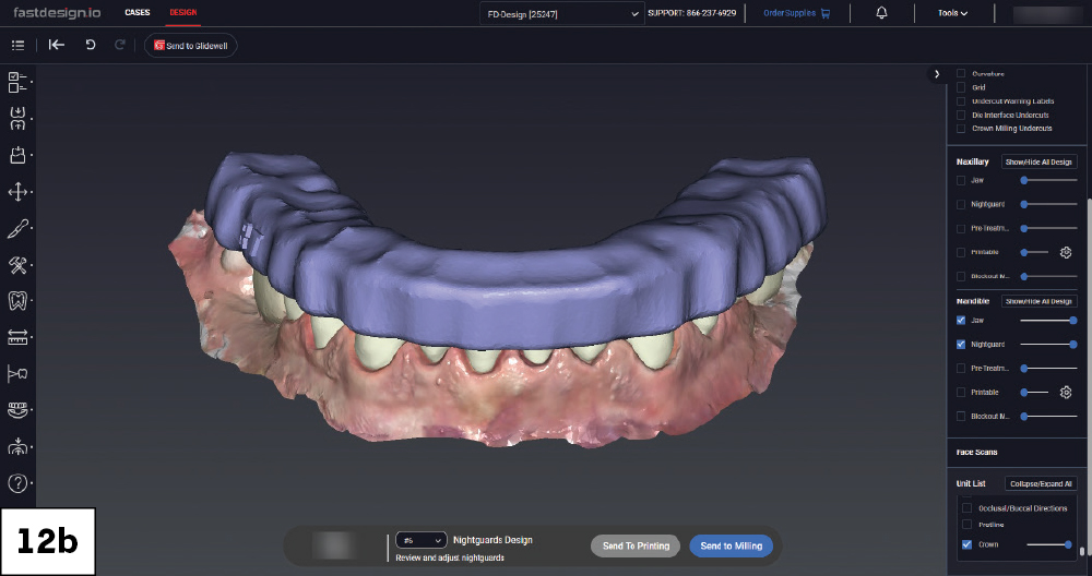 Nightguard design over the mandibular arch displayed in fastdesign.io, lateral view.