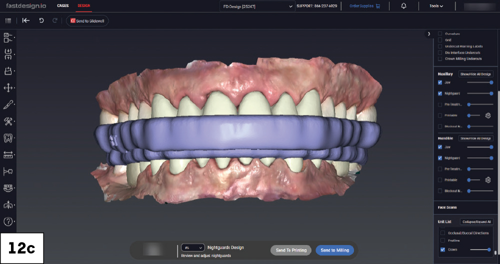 Full-mouth nightguard design shown over both arches in occlusion in fastdesign.io, facial view.