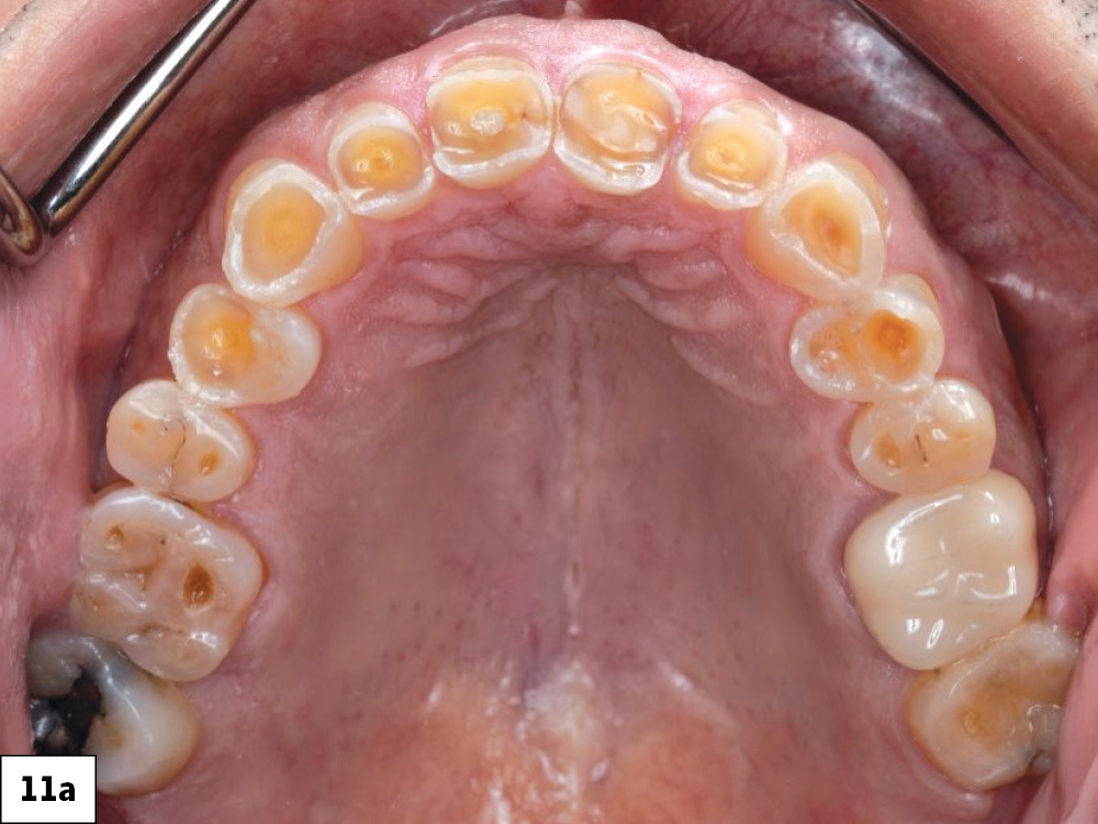 Pretreatment occlusal view of the maxillary arch showing generalized severe wear and decay.