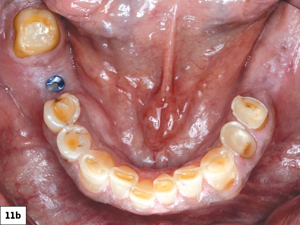 Pretreatment occlusal view of the mandibular arch showing severely worn and missing teeth with visible implant cover screw.