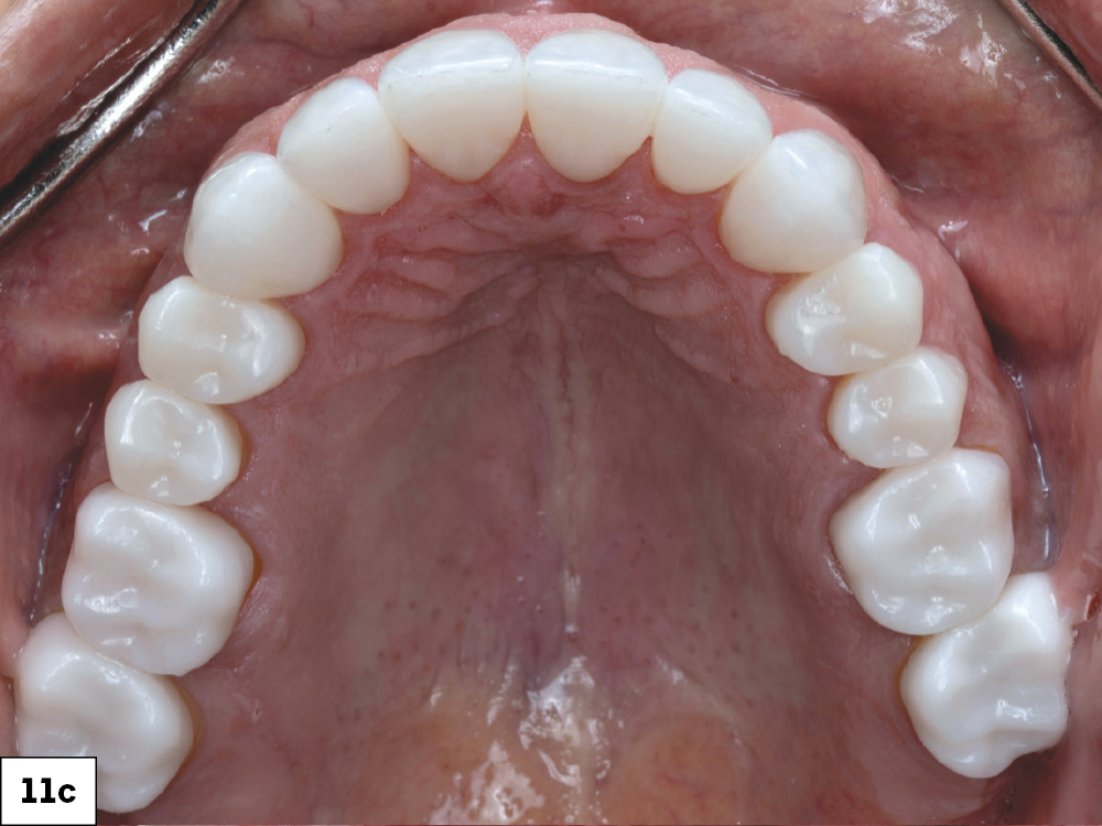 Post-treatment occlusal view of the maxillary arch with completed full-mouth BruxZir restorations.