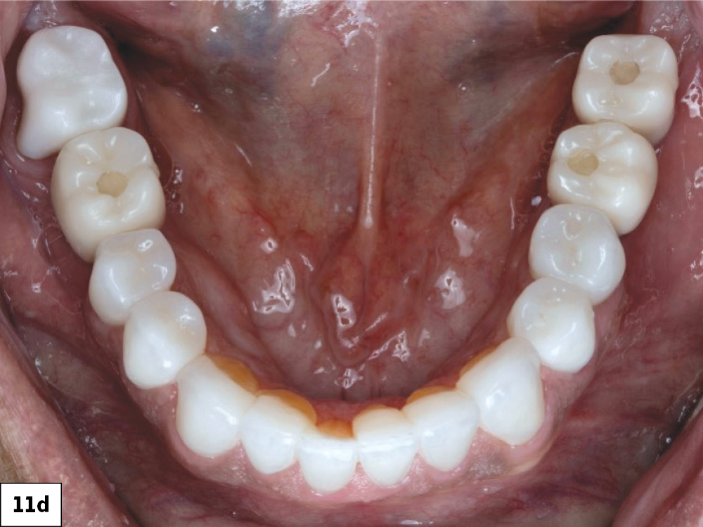 Post-treatment occlusal view of the mandibular arch with completed BruxZir crowns, veneers, and implant restorations.