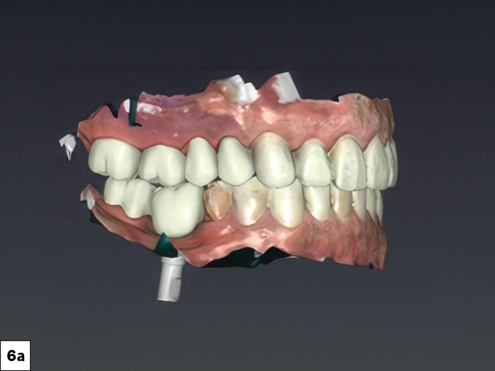 3D intraoral scan showing both arches in occlusion with mandibular implant scan bodies visible, lateral view.