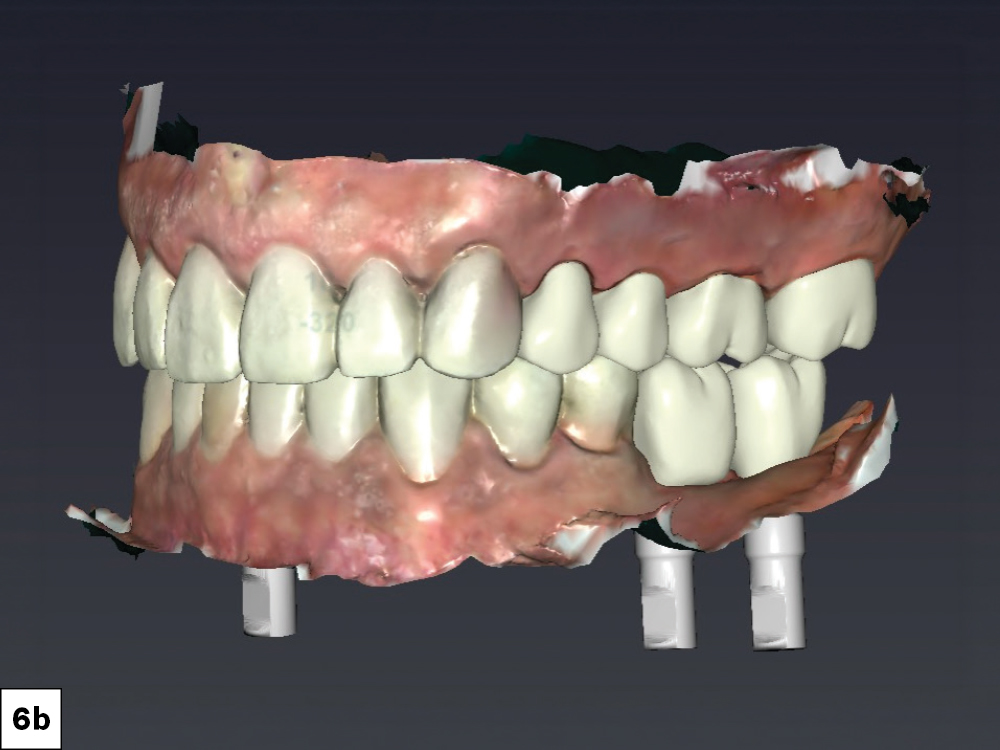 3D intraoral scan showing both arches in occlusion with mandibular implant scan bodies visible, facial view.