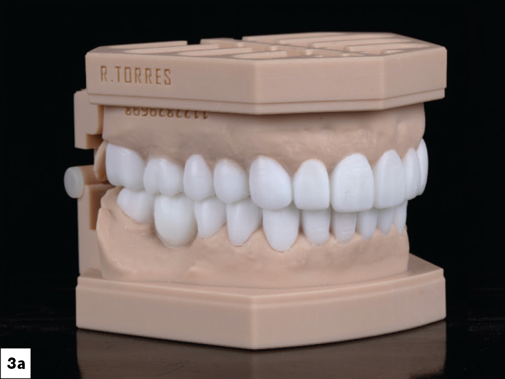 Lateral view of full-mouth diagnostic wax-up on articulated stone models showing planned tooth contours and VDO.