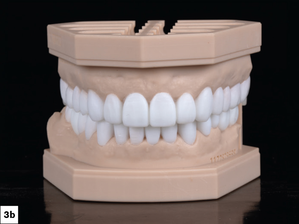 Facial view of full-mouth diagnostic wax-up on articulated stone models showing anticipated anterior esthetic outcome.